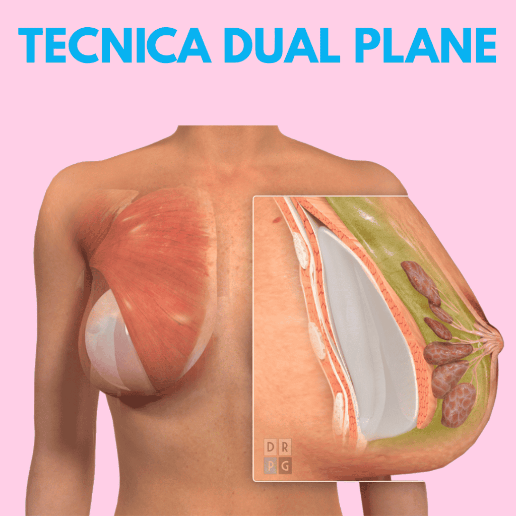 Illustrazione medica della tecnica dual plane per mastoplastica additiva, con protesi posizionata sotto il muscolo e tessuti mammari in sezione anatomica.