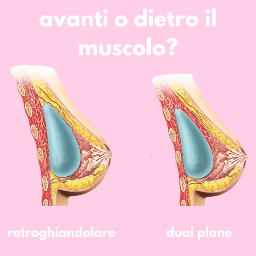 Confronto visivo tra posizionamento retroghiandolare e tecnica dual plane nella mastoplastica additiva, con illustrazioni anatomiche in sezione.