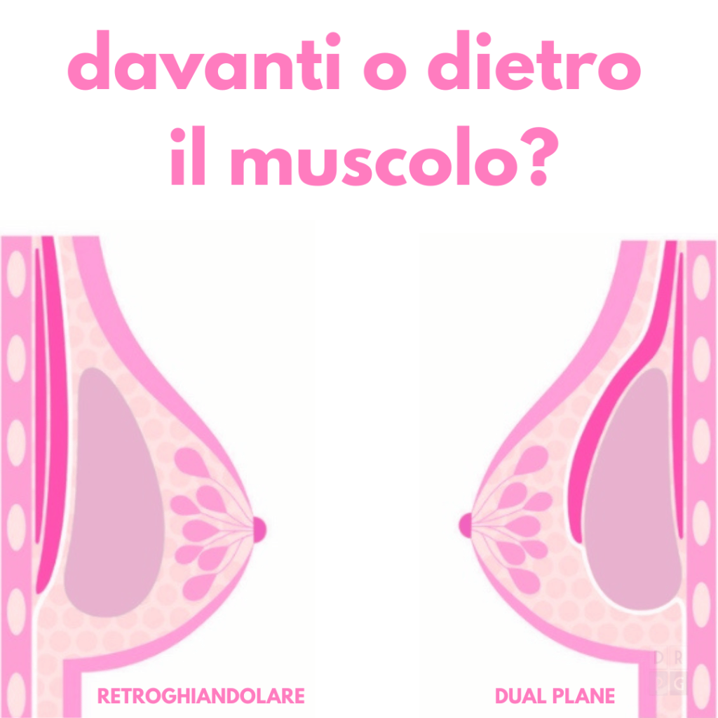 confronto tra posizionamento sottoghiandolare e dual plane nella mastoplastica additiva per spiegare se la protesi va davanti o dietro il muscolo