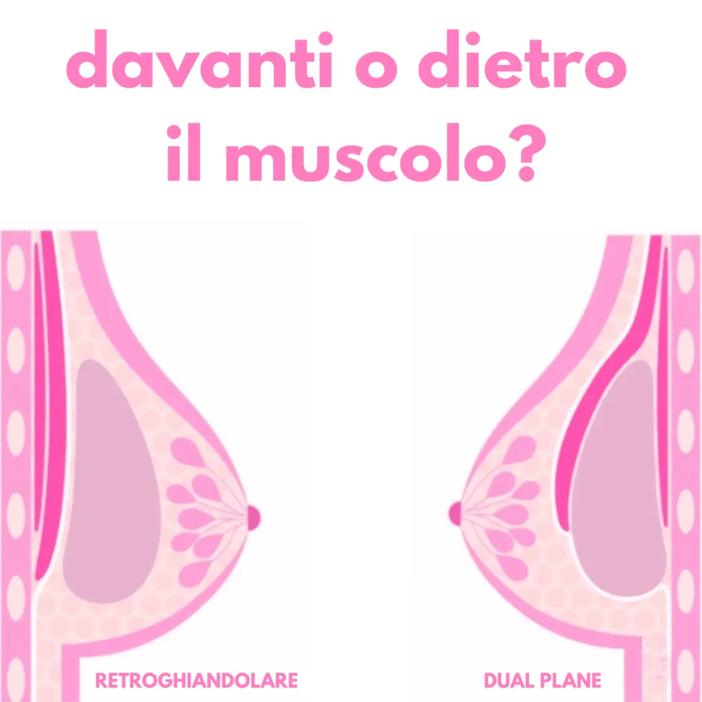 confronto tra posizionamento sottoghiandolare e dual plane nella mastoplastica additiva per spiegare se la protesi va davanti o dietro il muscolo