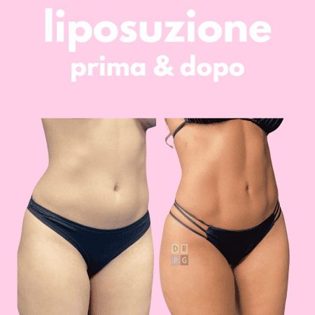 Risultato prima e dopo della liposuzione: addome e fianchi rimodellati con effetto naturale.
