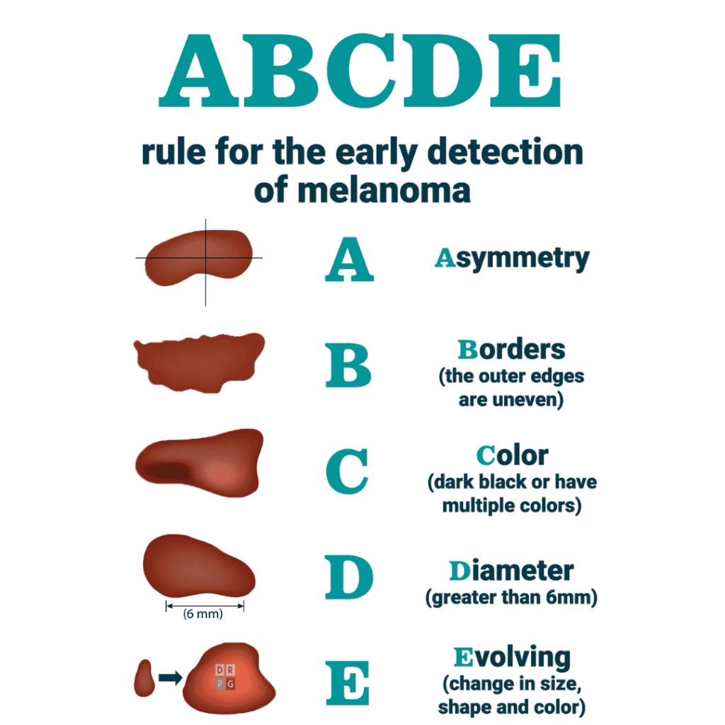 early detection of malignant melanoma in milan