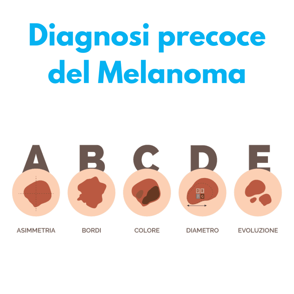 diagnosi precoce melanoma a milano con il dr. gigliofiorito