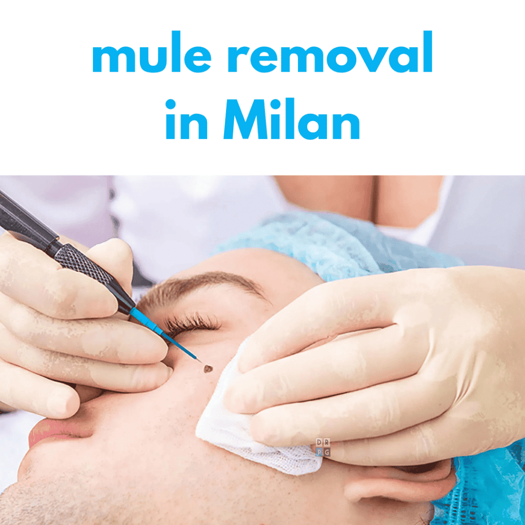 mole removal milan dr pierluigi gigliofiorito plastic surgeon