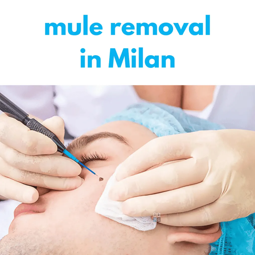 mole removal milan dr pierluigi gigliofiorito plastic surgeon