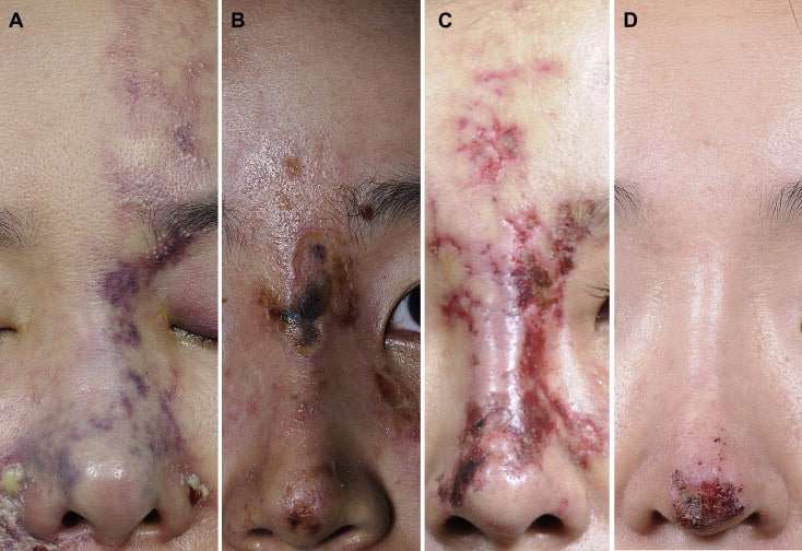 necrosi cutanea dopo rinofiller