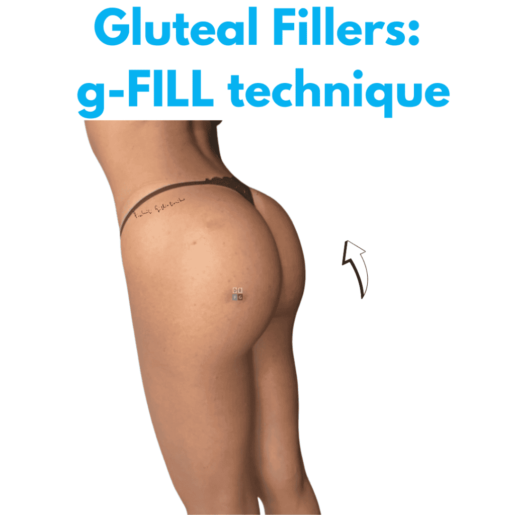 non-surgical buttock enhancement in Milan with hyaluronic and polylactic acid gluteal fillers by Dr. Pierluigi Gigliofiorito.