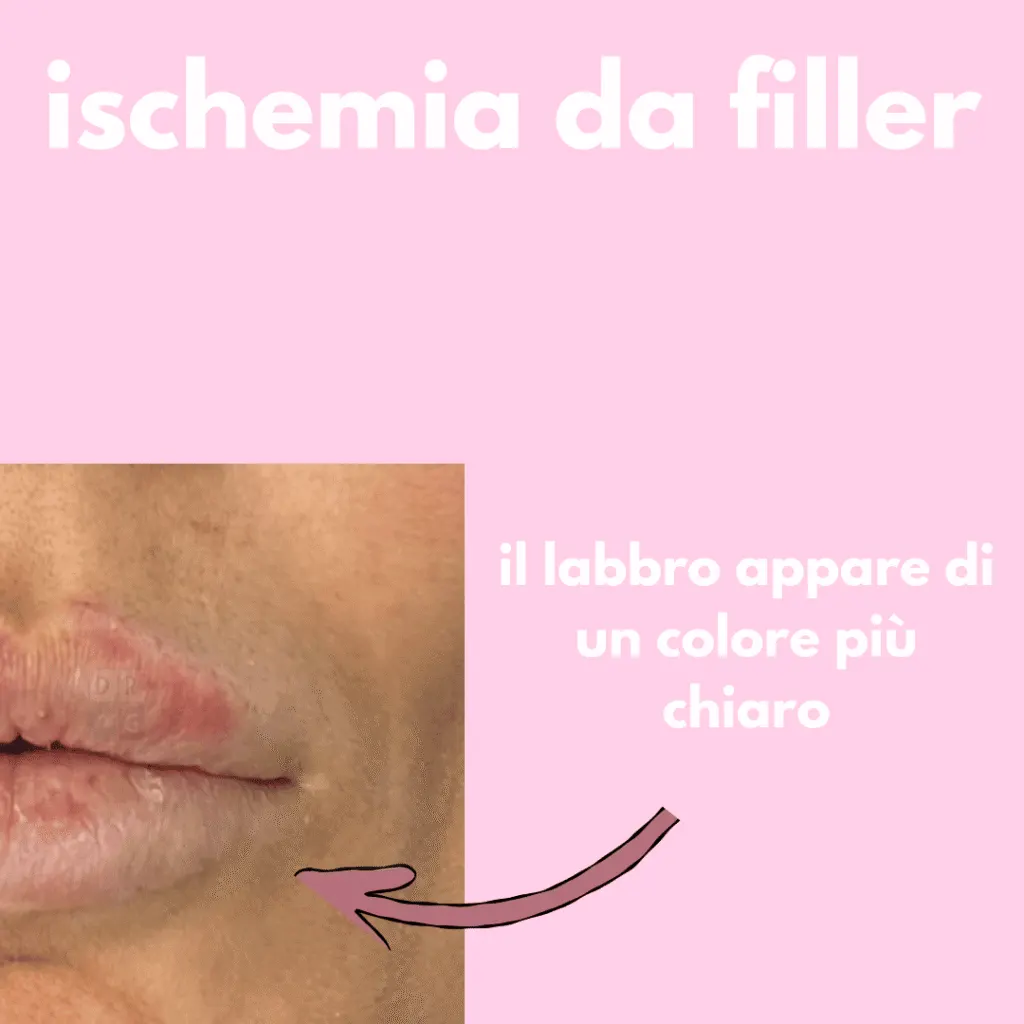 ischemia da filler labbra segni iniziali colore più chiaro