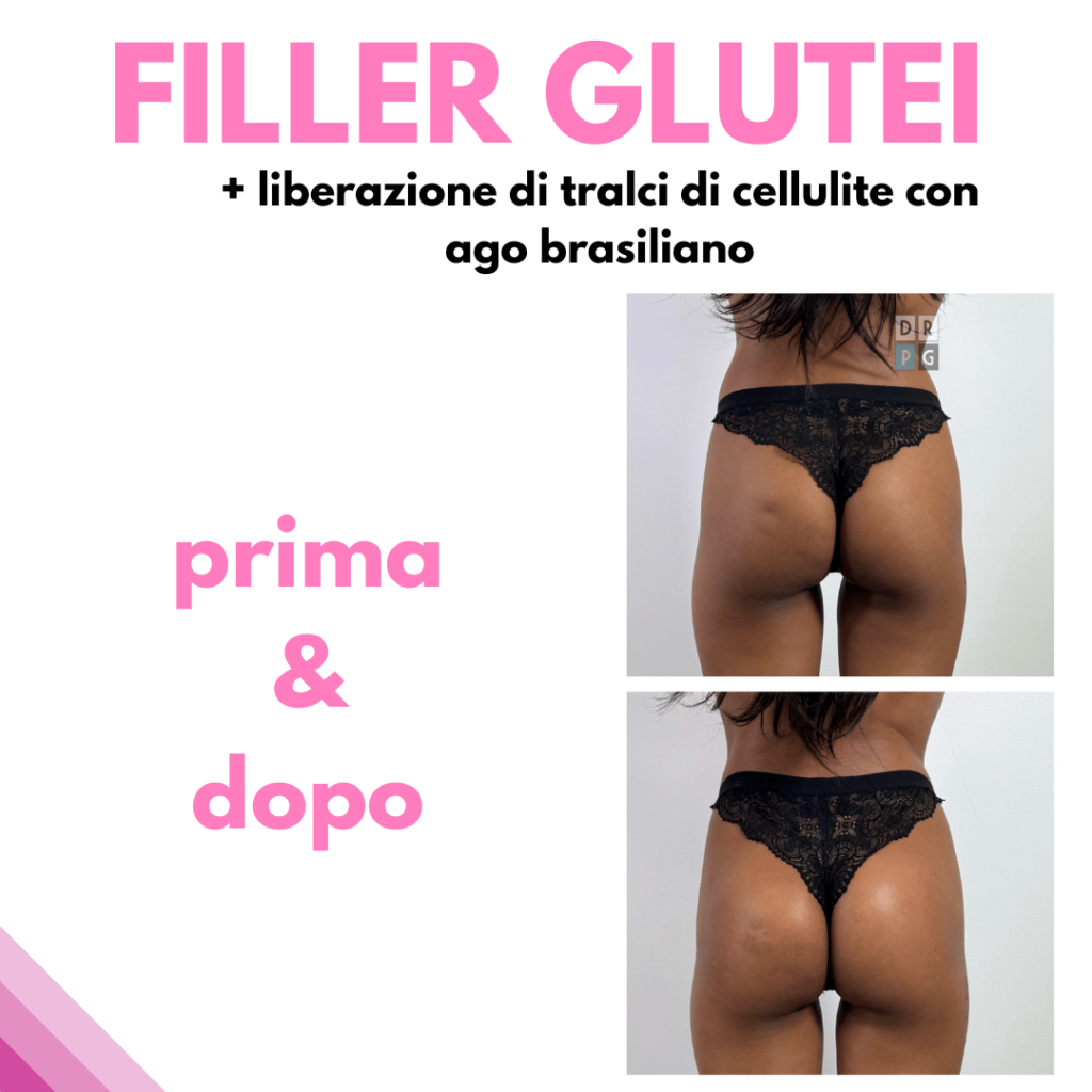 Filler glutei prima e dopo con liberazione dei tralci di cellulite – Dr. Pierluigi Gigliofiorito
