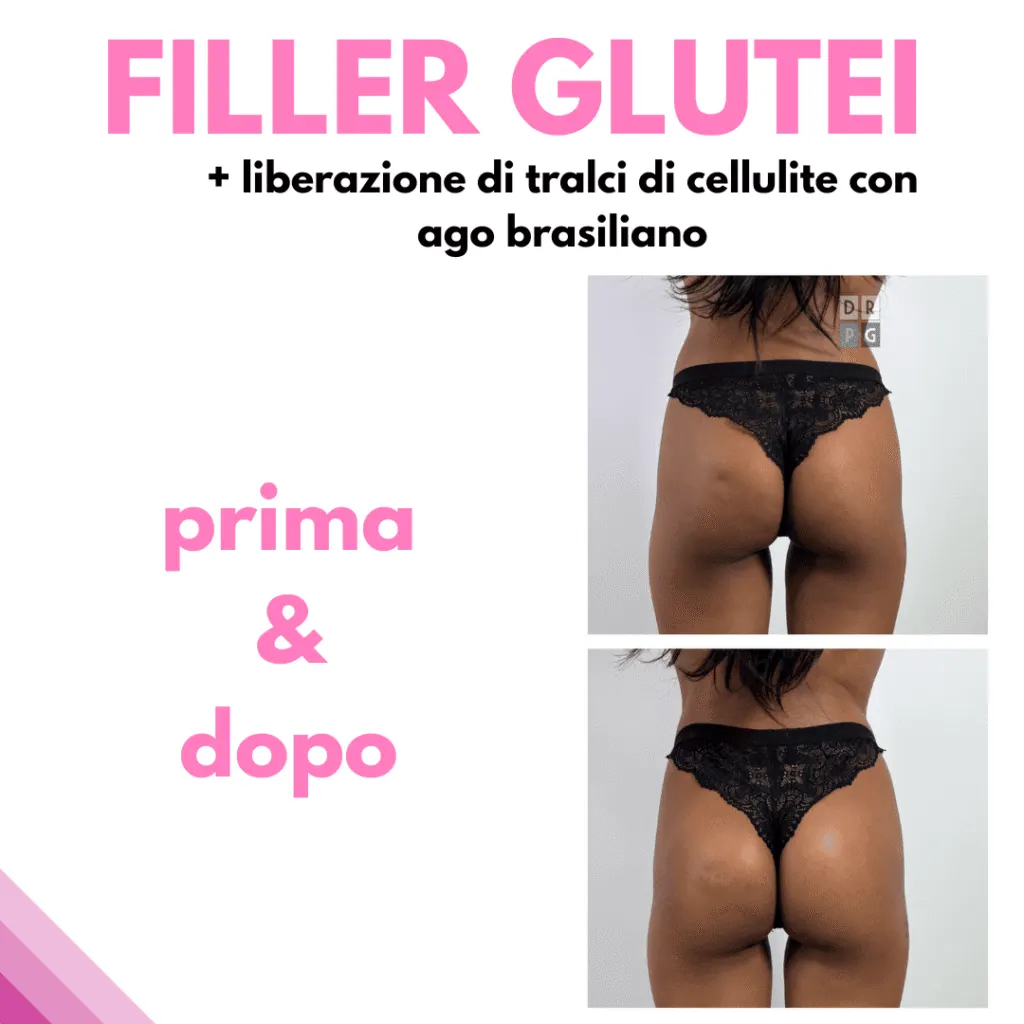 Filler glutei prima e dopo con liberazione dei tralci di cellulite – Dr. Pierluigi Gigliofiorito
