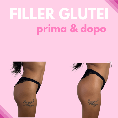 Filler glutei prima e dopo per rimodellamento e aumento del volume