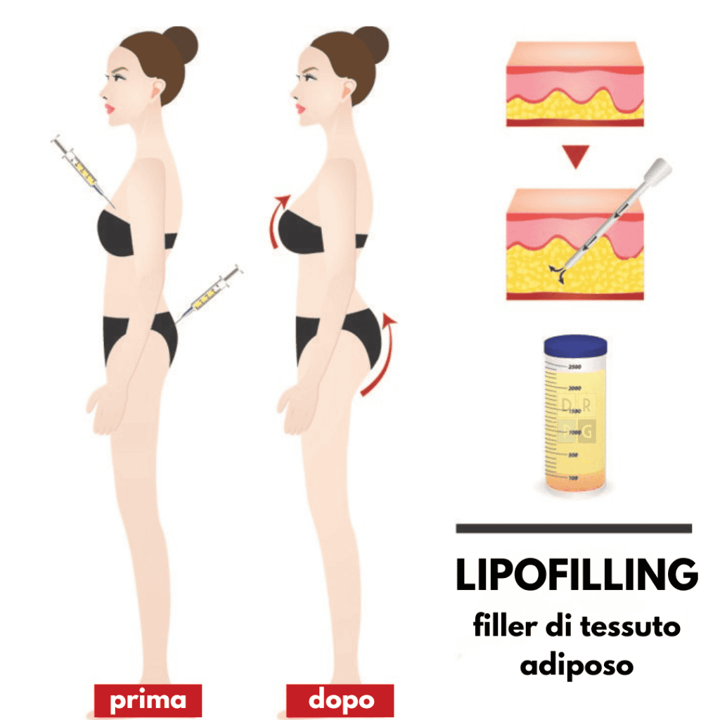 Lipofilling: esempio di filler con tessuto adiposo utilizzato per aumentare volume e rimodellare seno e glutei
