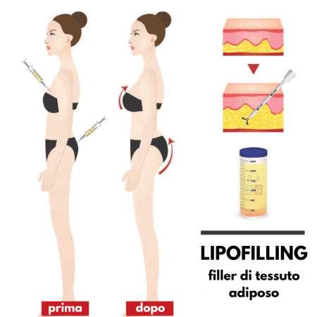 Lipofilling: esempio di filler con tessuto adiposo utilizzato per aumentare volume e rimodellare seno e glutei
