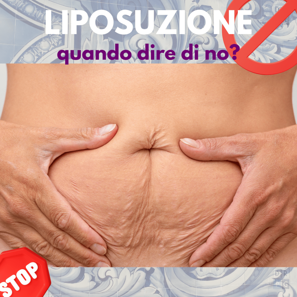 Addome con marcata lassit&agrave; cutanea: condizione in cui la liposuzione non &egrave; indicata
