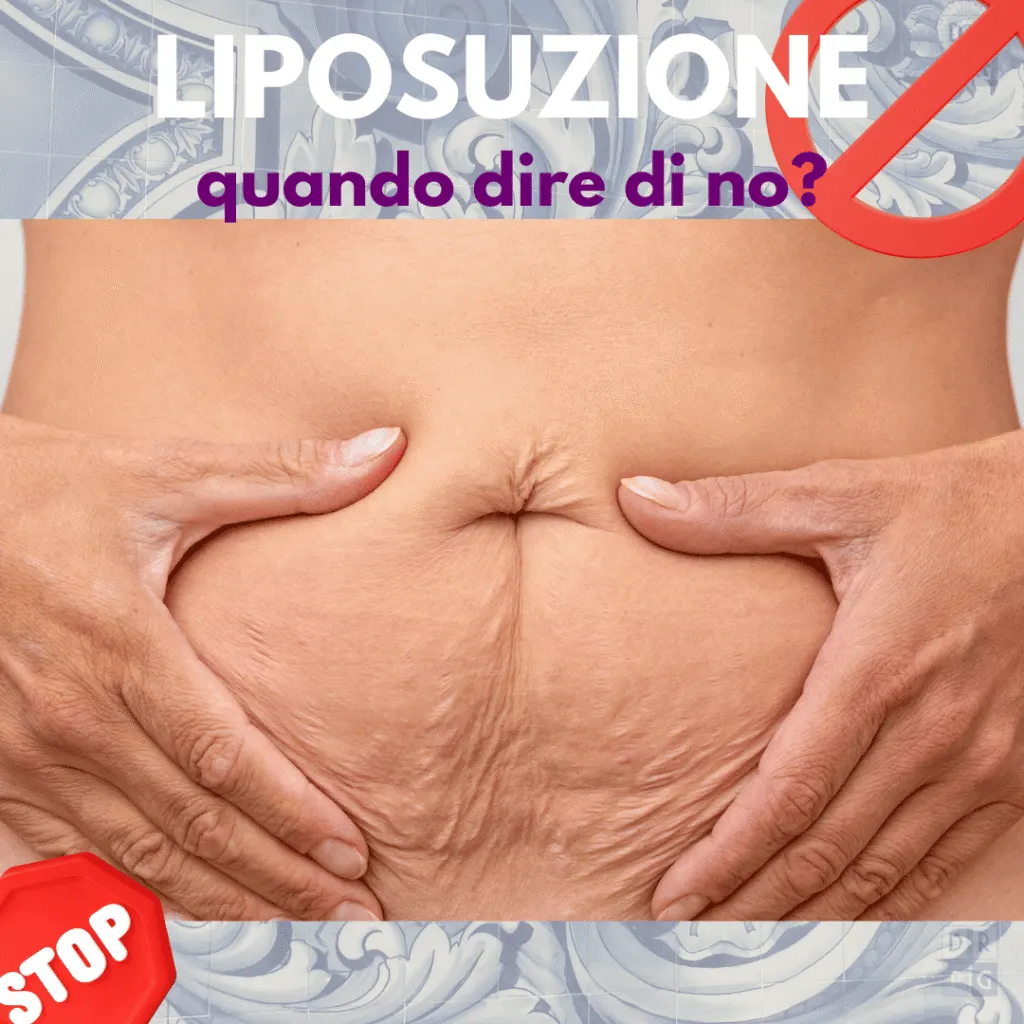 Addome con marcata lassità cutanea: condizione in cui la liposuzione non è indicata
