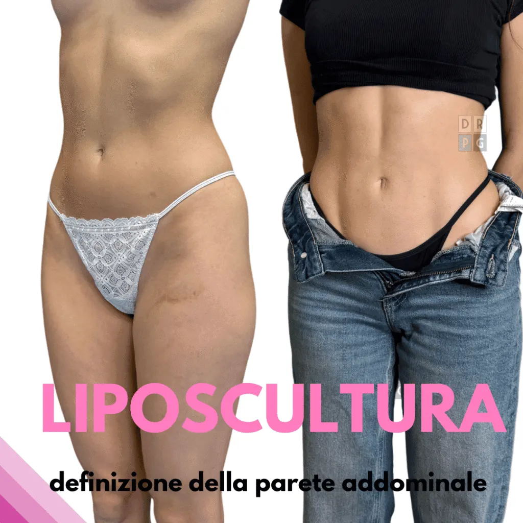 Prima e dopo liposcultura addominale con riduzione del grasso localizzato e miglioramento del profilo