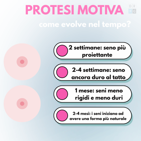 Evoluzione nel tempo delle protesi Motiva dopo mastoplastica additiva: proiezione e naturalezza