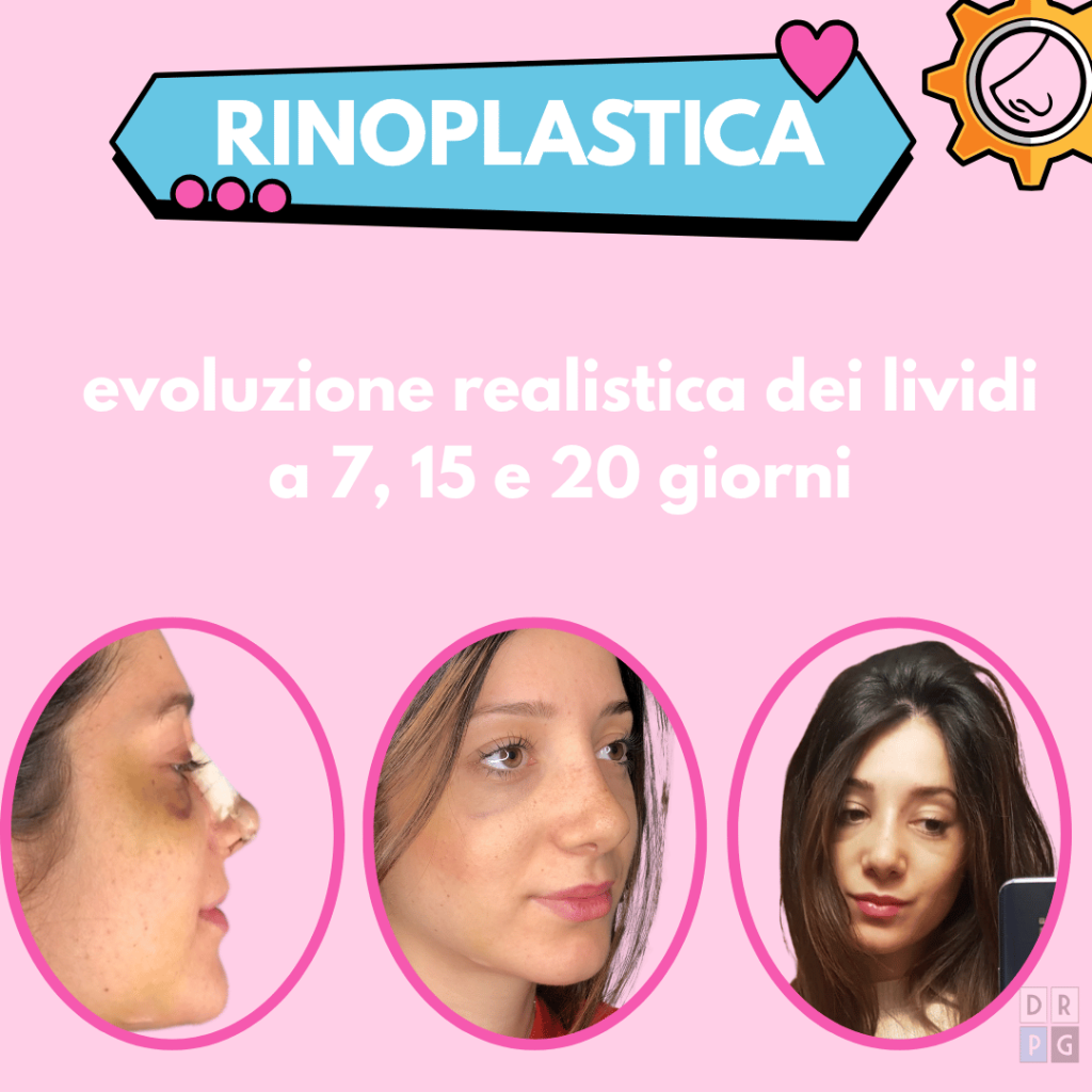 evoluzione lividi rinoplastica dopo 7 15 20 giorni naso post operatorio