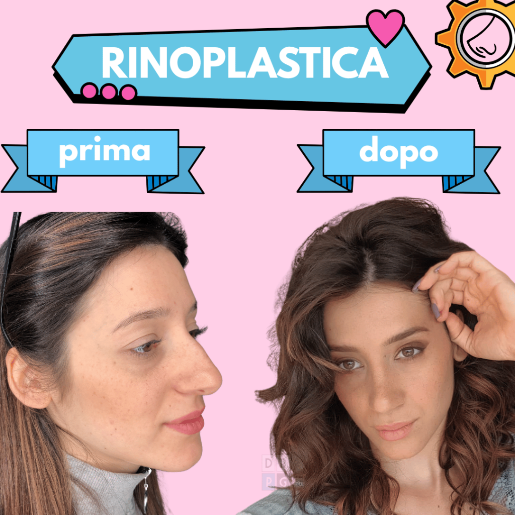 rinoplastica Milano prima e dopo risultato naturale armonia volto