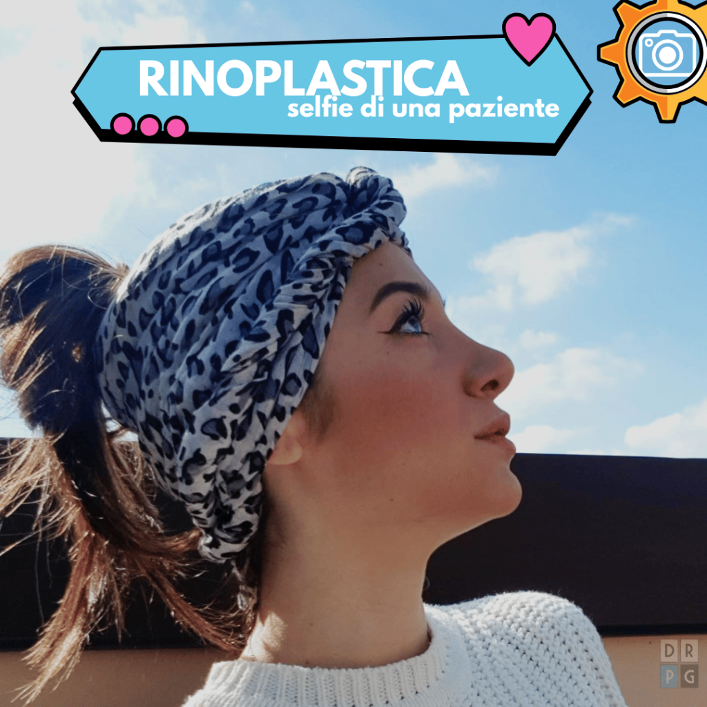 risultato rinoplastica naturale profilo naso armonico
