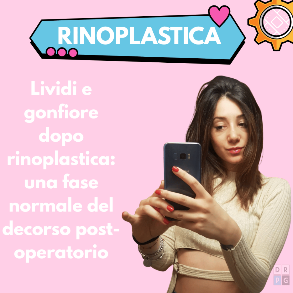 lividi dopo rinoplastica gonfiore naso post operatorio

