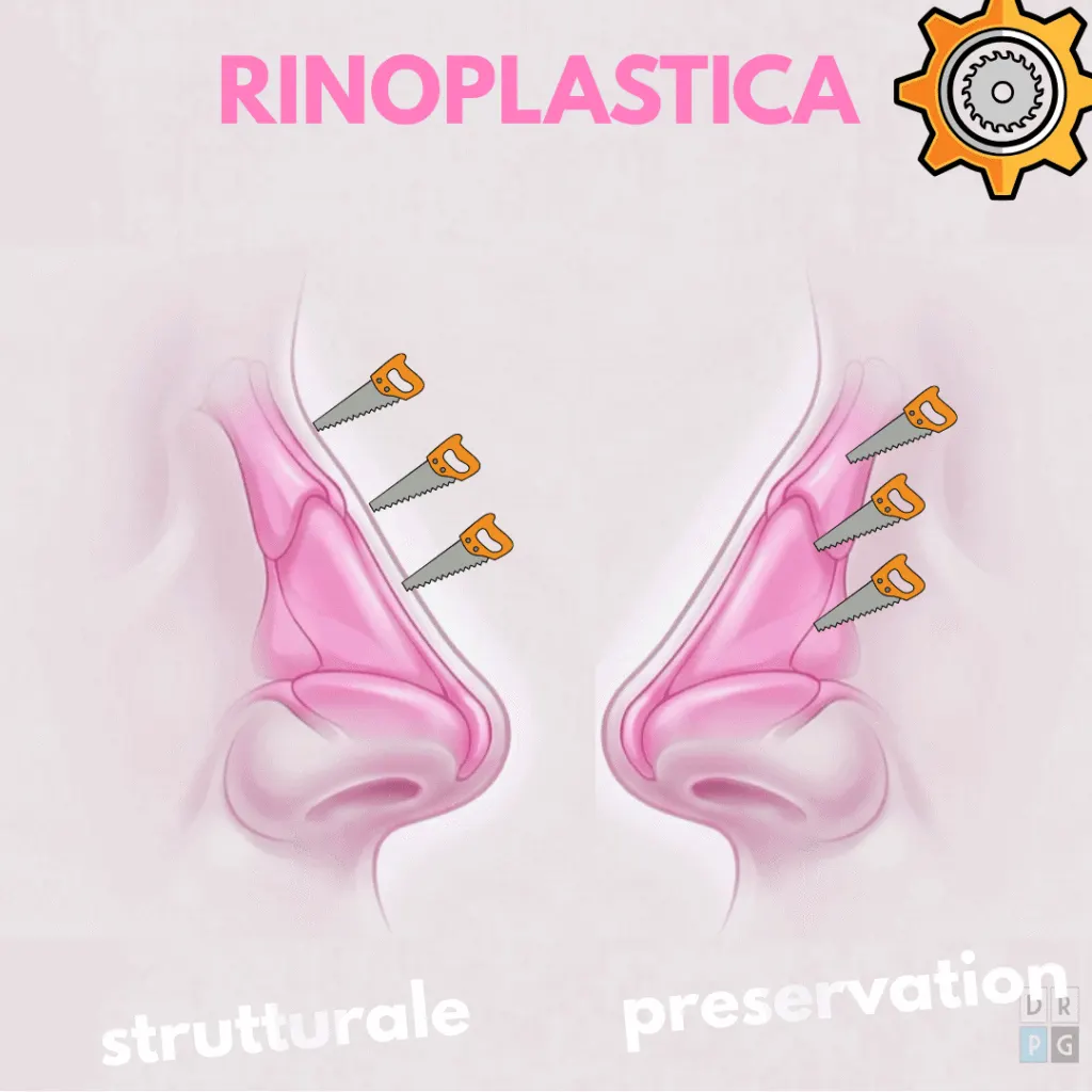 schema rinoplastica strutturale vs preservation differenze tecniche
