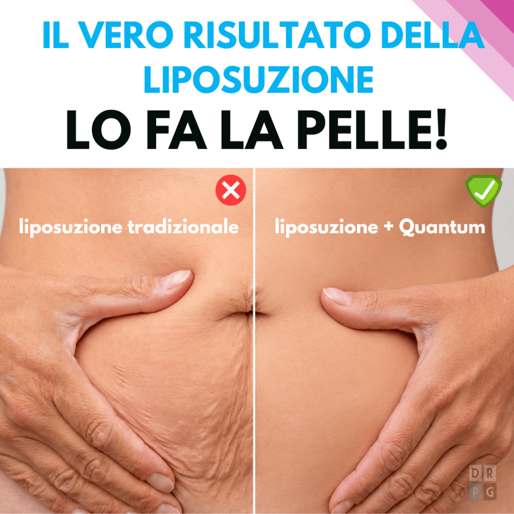 differenza tra liposuzione tradizionale e liposuzione con quantum sulla qualità della pelle
