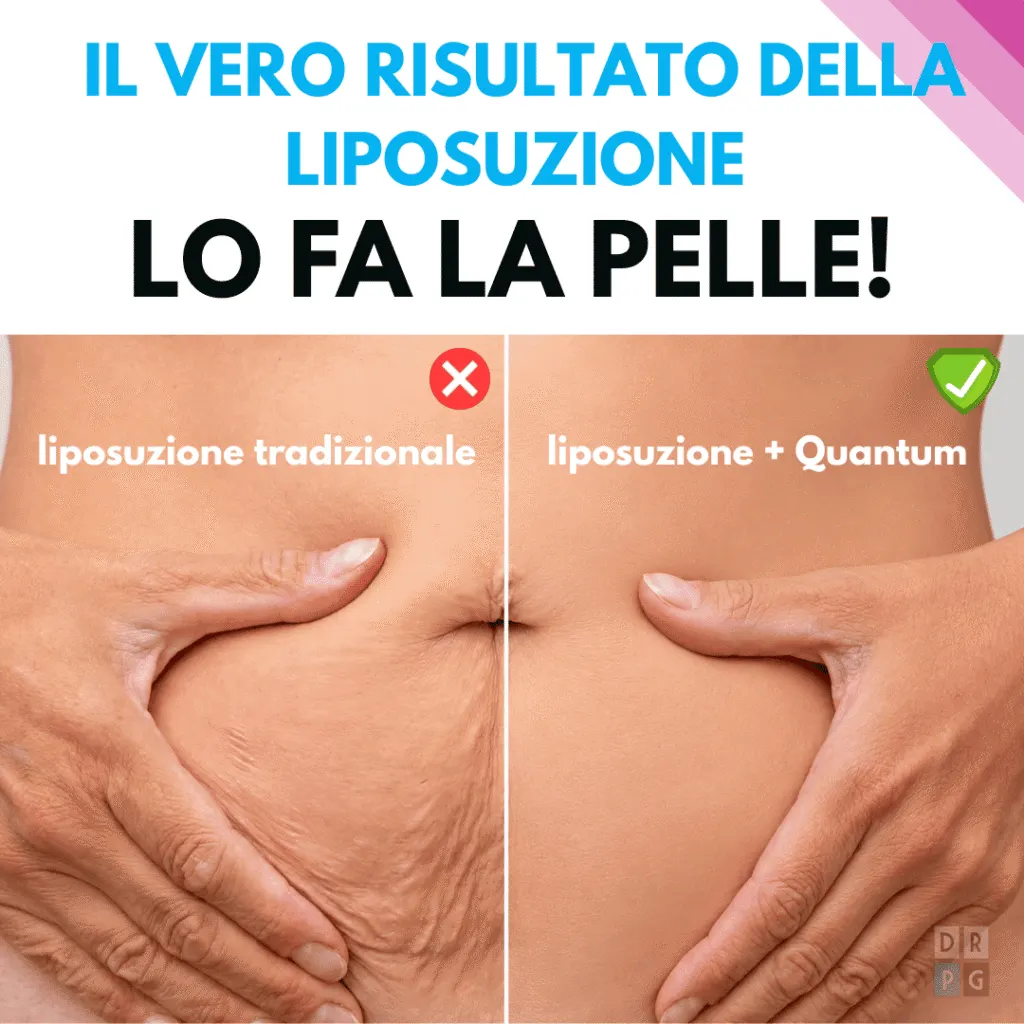 differenza tra liposuzione tradizionale e liposuzione con quantum sulla qualità della pelle
