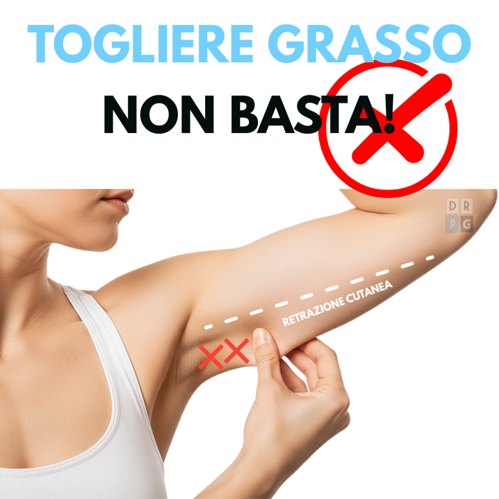 esempio di lassità cutanea dopo rimozione del grasso senza retrazione della pelle
