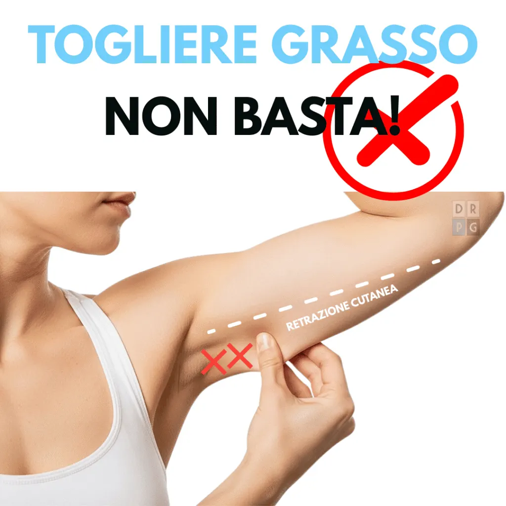 esempio di lassità cutanea dopo rimozione del grasso senza retrazione della pelle
