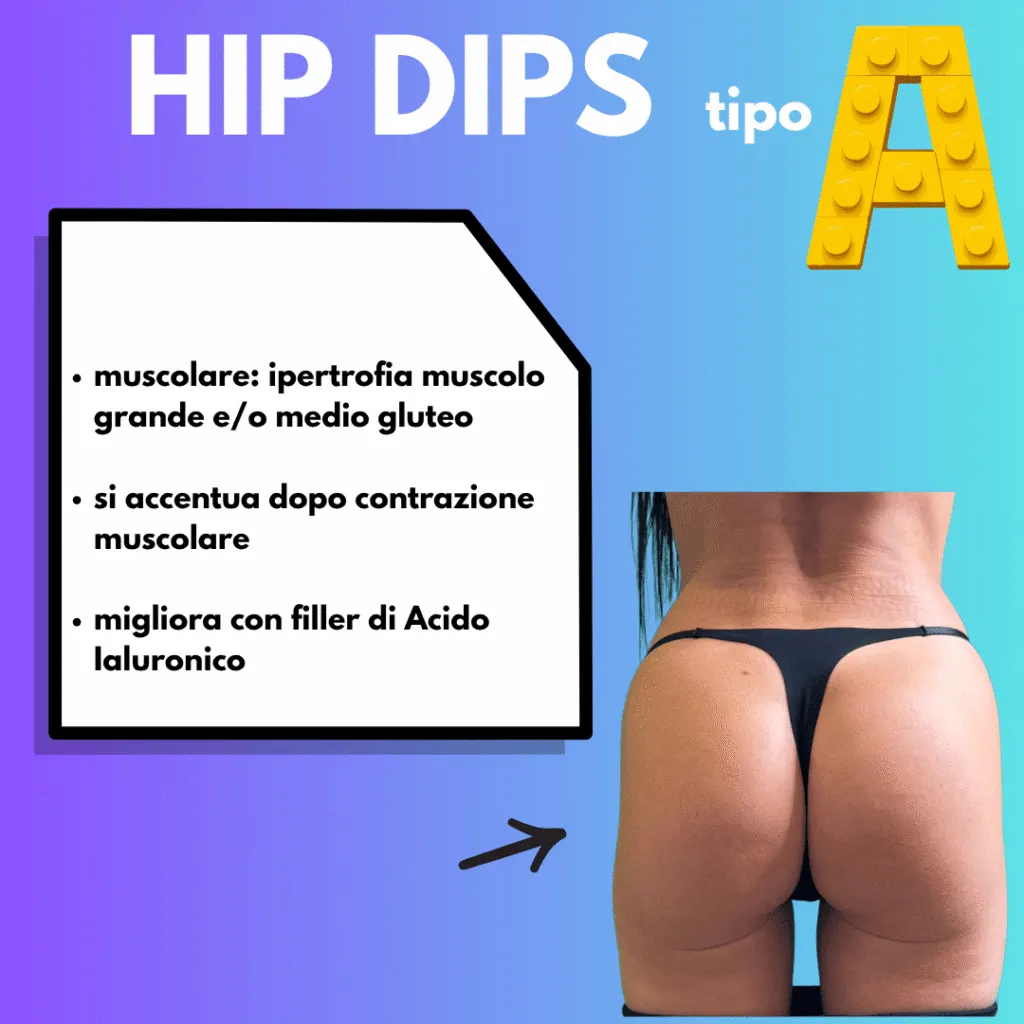Hip dips tipo A muscolare con depressione laterale accentuata dalla contrazione dei glutei
