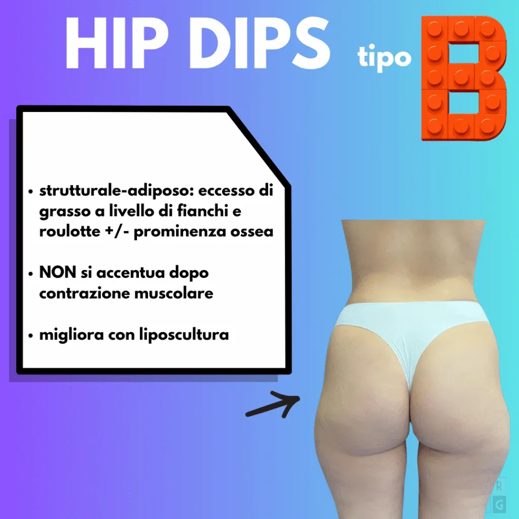 Hip dips tipo B strutturale-adiposo con accumulo di tessuto adiposo sui fianchi
