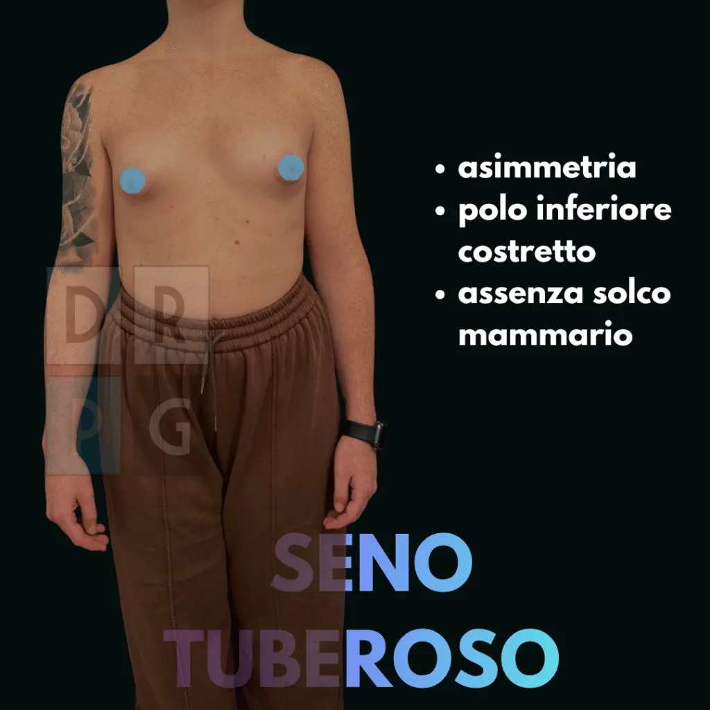Seno tuberoso con asimmetria, polo inferiore costretto e alterazione del solco mammario
