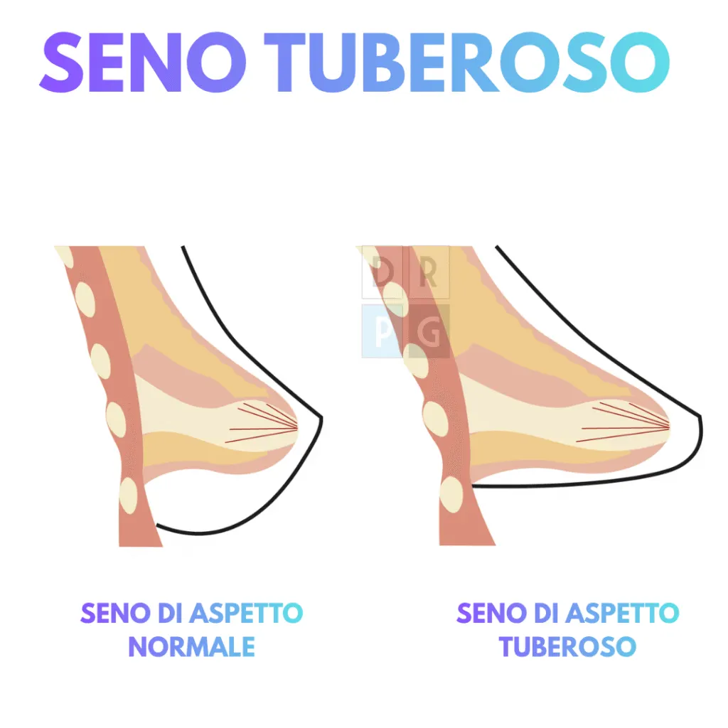 Schema delle differenze anatomiche tra seno normale e seno tuberoso
