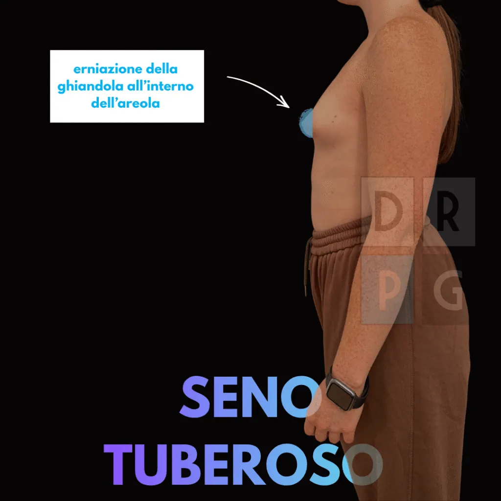 Seno tuberoso: erniazione della ghiandola nell’areola
