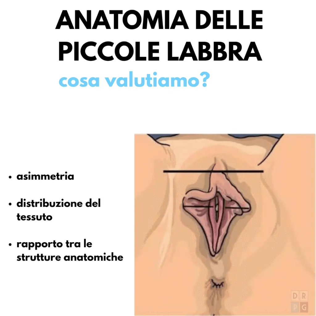 Schema anatomico delle piccole labbra e degli elementi valutati prima della labioplastica