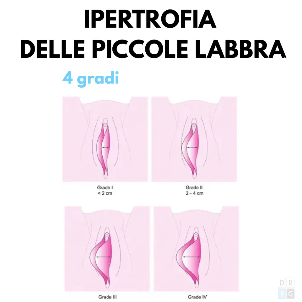 Schema dei diversi gradi di ipertrofia delle piccole labbra
