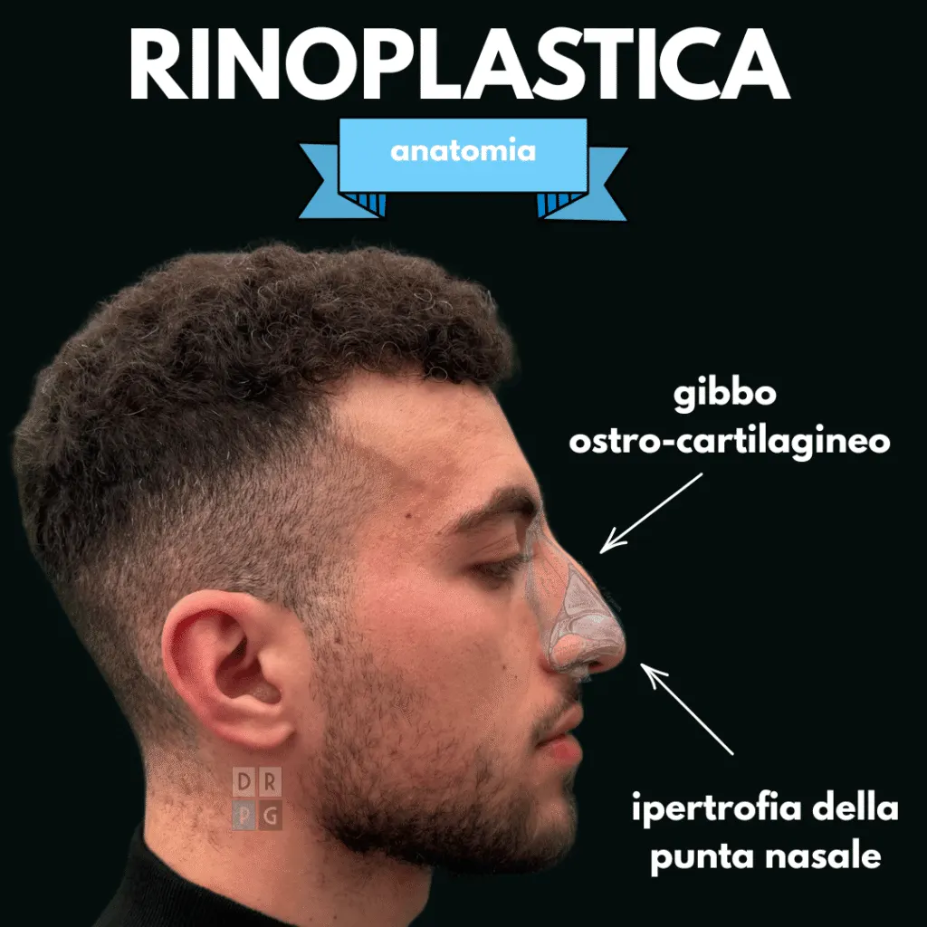 Profilo preoperatorio con gibbo osteo-cartilagineo e ipertrofia della punta nasale