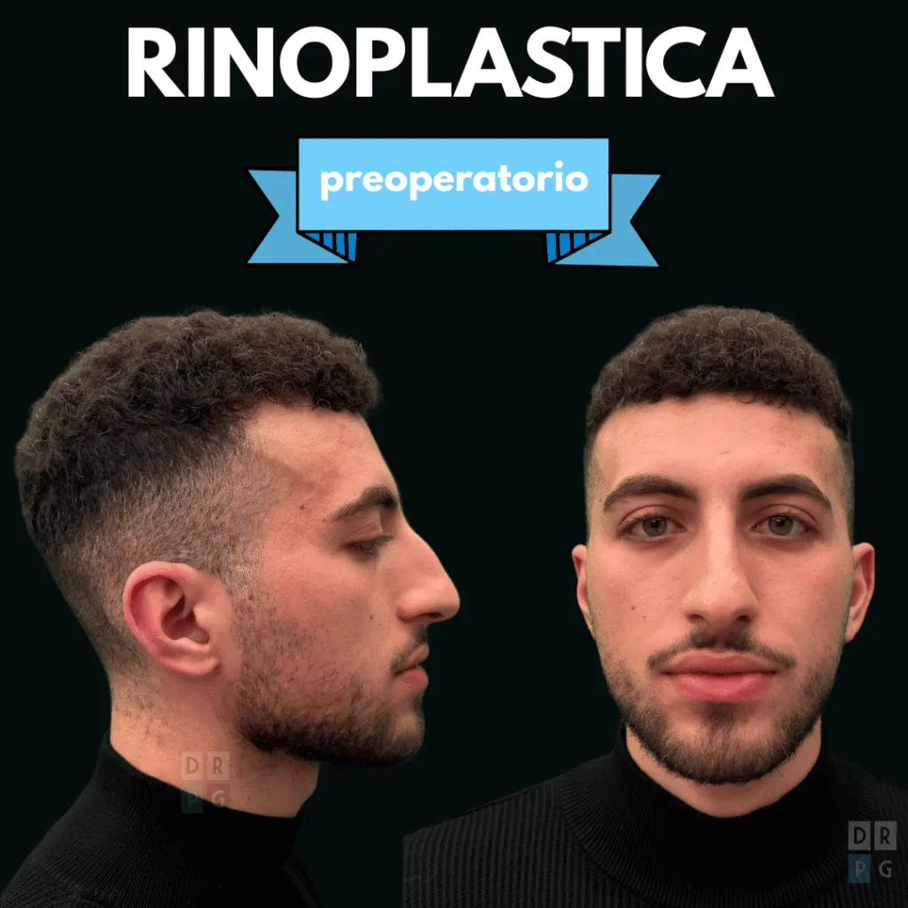 Rinoplastica maschile: naso con gobba prima dell'intervento