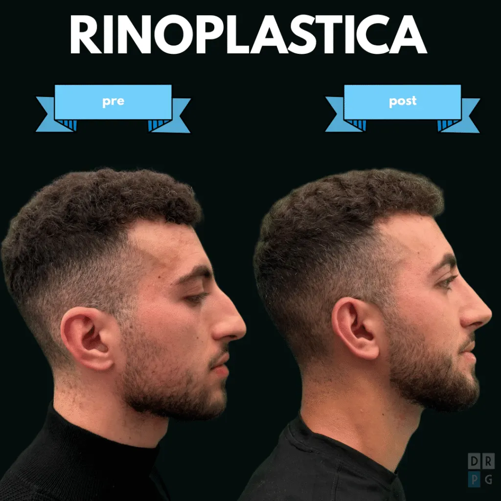 Rinoplastica maschile prima e dopo con correzione del gibbo e rimodellamento della punta