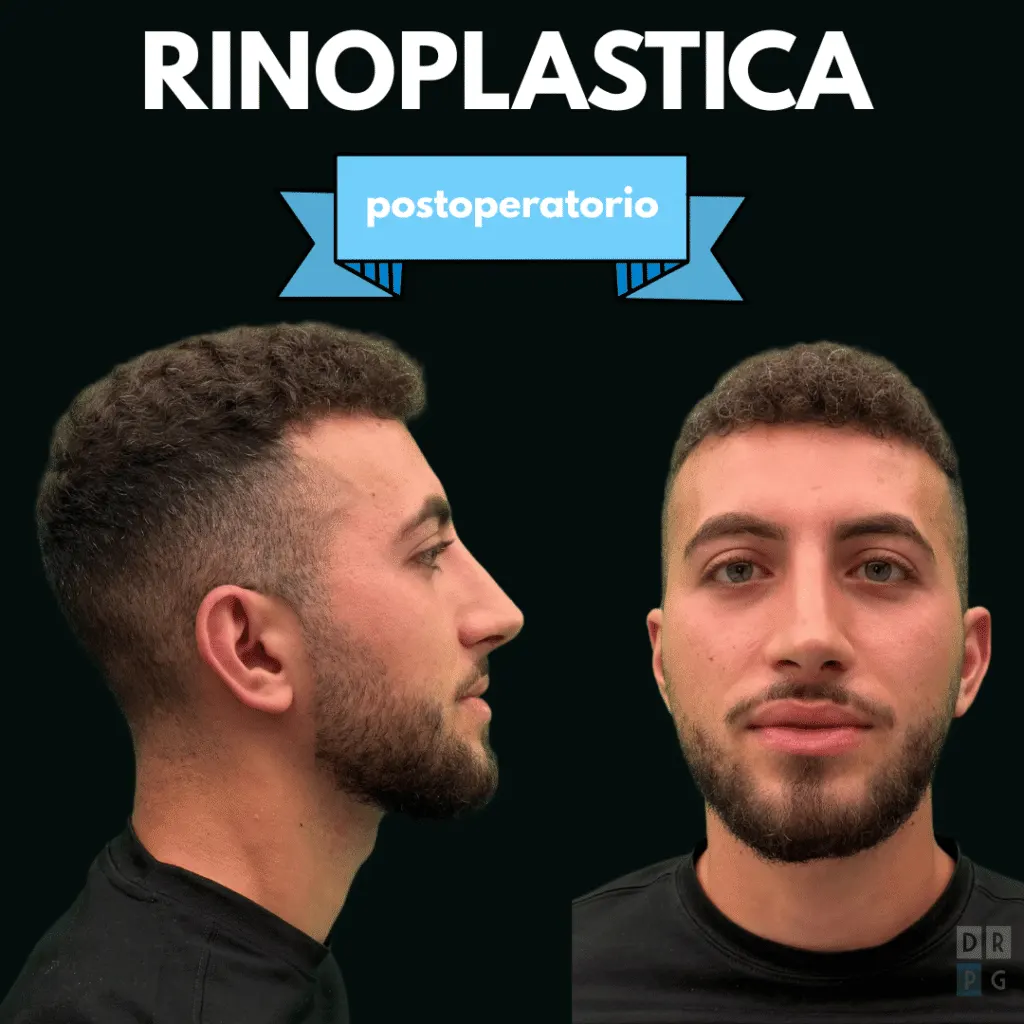 Risultato dopo rinoplastica maschile per correzione del gibbo e della punta